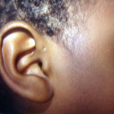 ear pit